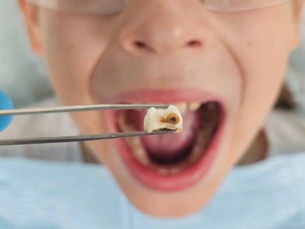 Best Emergency Tooth Extraction in Mechanicsburg, PA